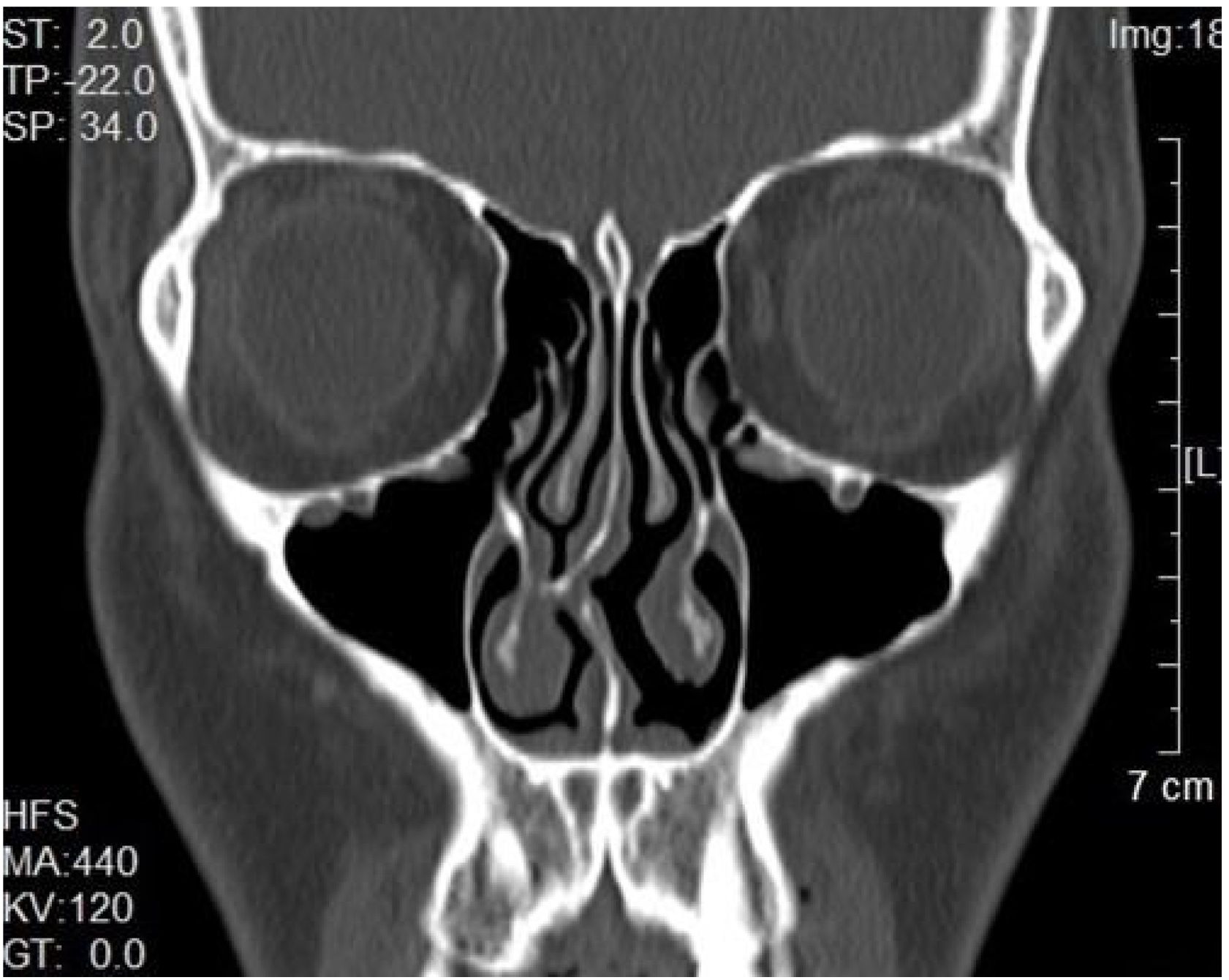 Reducing local tension to repair nasal septal deviation and spur ...