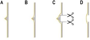 Schematic diagram of nasal septal deviation correction. In the deviated nasal septum, the spur is visible (A). The mucous chondrium and periosteum are separated above and below the spur (B). The bone connection above and below the spur is cut off to reduce the mucosal tension (C). Then the spur and the nasal septum are separated (D).