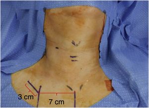 Skin incision site. A 30 mm skin incision was made in the subclavian area, located 7 cm from sternal notch.