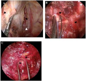 Operative procedures. (a) Central approach technique for accessing the thyroid lobe. A white arrowhead indicates the midline, and a black arrow indicates the right sternohyoid muscle. The right sternocleidomastoid muscle was retracted to left (black arrowhead). (b) The right external branch of superior laryngeal nerve (black arrowhead) was identified by nerve integrity monitor. The black arrow indicates the right cricothyroid muscle. The white arrowhead indicates the trachea. (c) The right RLN (black arrowhead) was identified near the right superior parathyroid (black arrow).