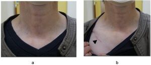 Postoperative wounds. (a and b) The subclavian wound (black arrowhead) along the skin crease is concealed under regular clothing. The images show a patient one year after undergoing right thyroid lobectomy via the VANS method.