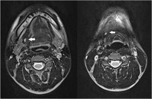T2-weighted magnetic resonance imaging of the neck. The luminal structure extends from the surface of the right lateral anterior neck to the right oral floor.