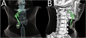 Cervical three-dimensional computed tomography fistulography. (A) The fistulous tract extends from the right lateral neck surface to the floor of the mouth. (B) A dendritic spread of contrast is observed at the root of the tongue.