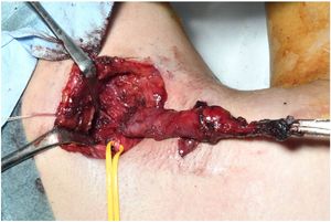 Cervical parallel skin incisions. An elliptical incision around the cervical orifice and a 7-cm transverse skin incision at the level of the hyoid bone are made. The fistulous duct is dissected upward from the surrounding tissue, appearing to taper and branch at the tongue root. A yellow vascular tape is applied over the hypoglossal nerve.