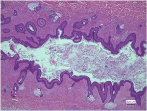 Micrograph of the section of the tract. The luminal surface is noted to be covered by squamous epithelium. Skin appendage-like structures, including sebaceous glands, sweat glands, and hair follicles, are observed. Salivary gland-like mixed mucous-plasma glands and conduits are also observed in the subepithelial areas.