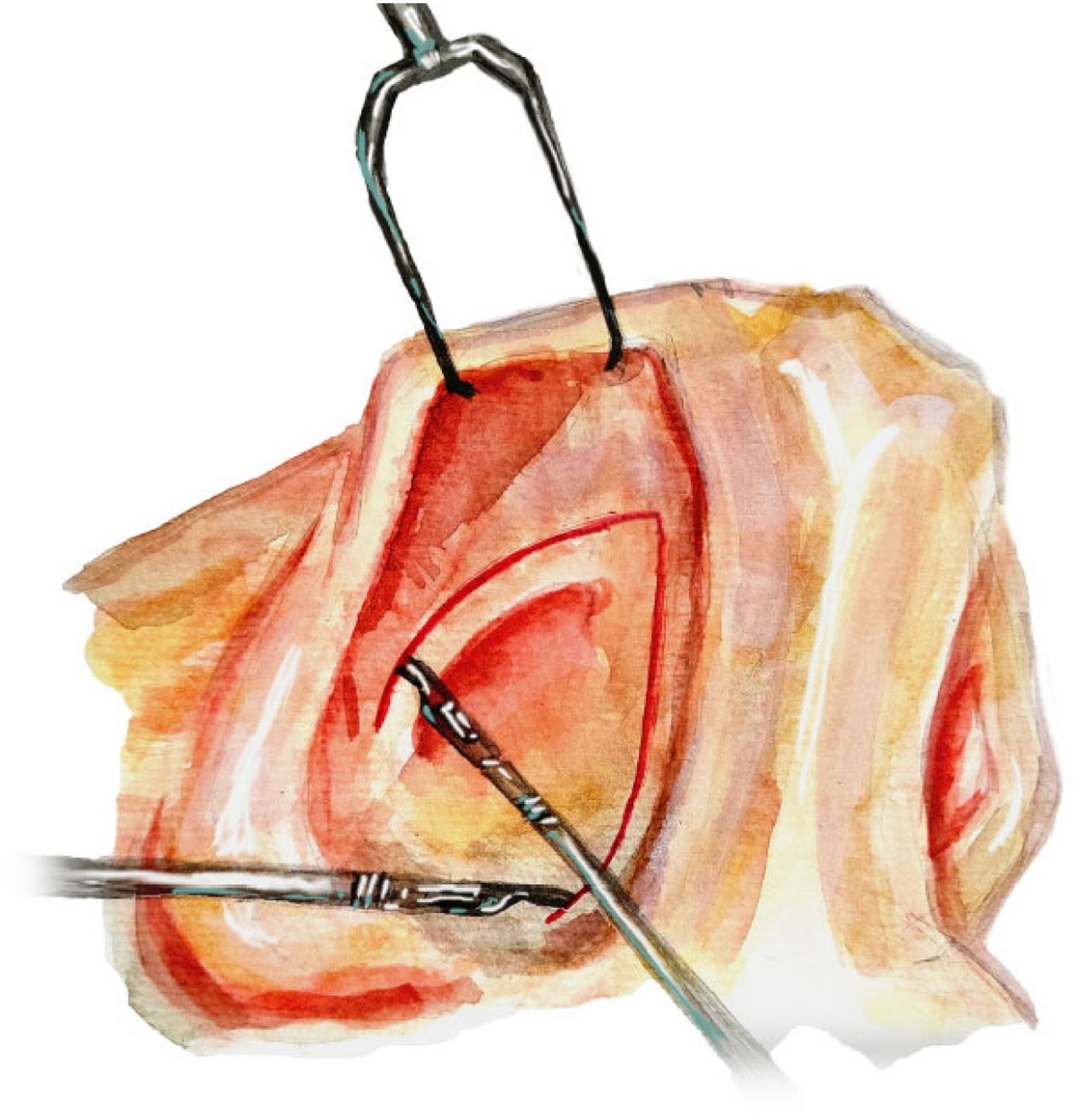 Effectiveness of bony batten grafting for correction of caudal septal ...