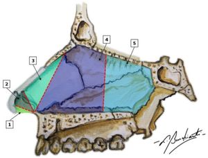 Schematic view of the lateral nasal septum according to the Cottle classification. (1) Area 1 ‒ Nasal or caudal vestibule; (2) Area 2 ‒ Internal nasal valve; (3) Area 3 ‒ Atrium; (4) Area 4 ‒ Turbinate’s region; (5) Area 5 ‒ Sphenopalatine region.