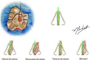 Anterior deviations found in patients. Mixed deviation: association of horizontal and vertical deviations. Horizontal deviation: deviation convexity with greater amplitude in the longitudinal axis. Vertical deviation: deviation convexity with greater amplitude in the vertical axis. Blocked: septum deviated from the central axis of the anterior nasal spine.