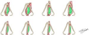 Fixing the bone batten to correct the deviations, preferably positioning the graft on the side contralateral to the deviation (concave side).