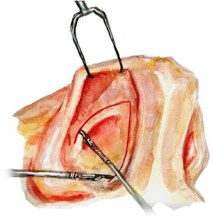 Closed access through intercartilaginous and transfixing incision.