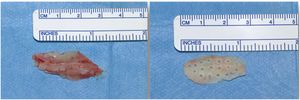 Left image: Bone removed for grafting. Image on the right: Bone prepared for use as a batten.