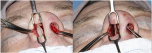 Patient with mixed deviation requiring a transverse position graft fixed to the quadrangular cartilage of the septum to correct the deviation.