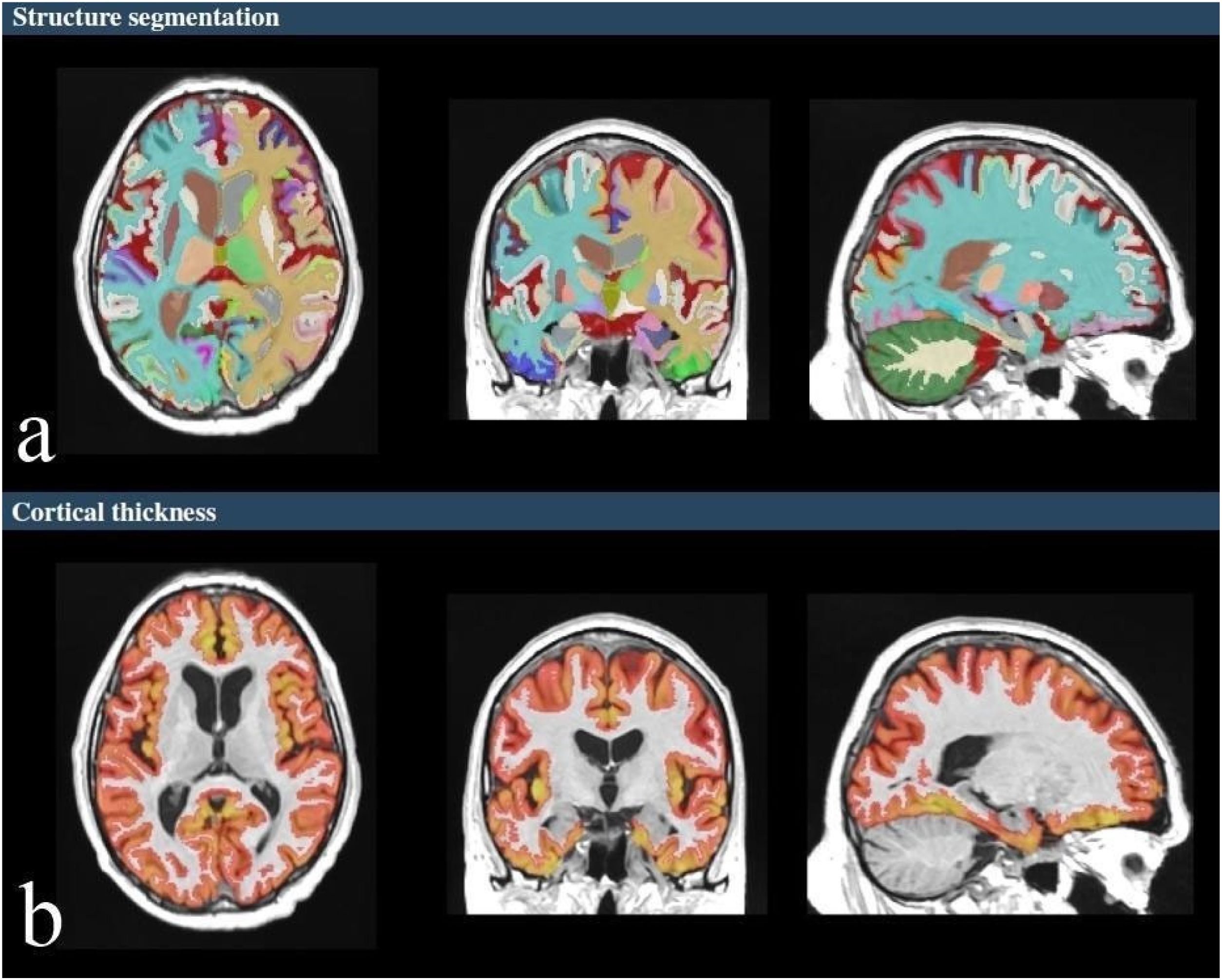 Segmented Structures Morphometric evaluation of cerebral and cerebellar structures in long ...