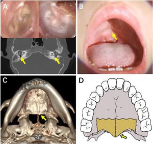 Case 12. (A) Otoscope and CT scan on temporal bone. (B) An inverted V-shaped depression at the junction of the soft palate and the hard palate. (C) The three-dimensional reconstruction of the maxillary CT scan confirmed the absence of posterior nasal spine. (D) The hand drawing shows a complete posterior nasal spine structure.