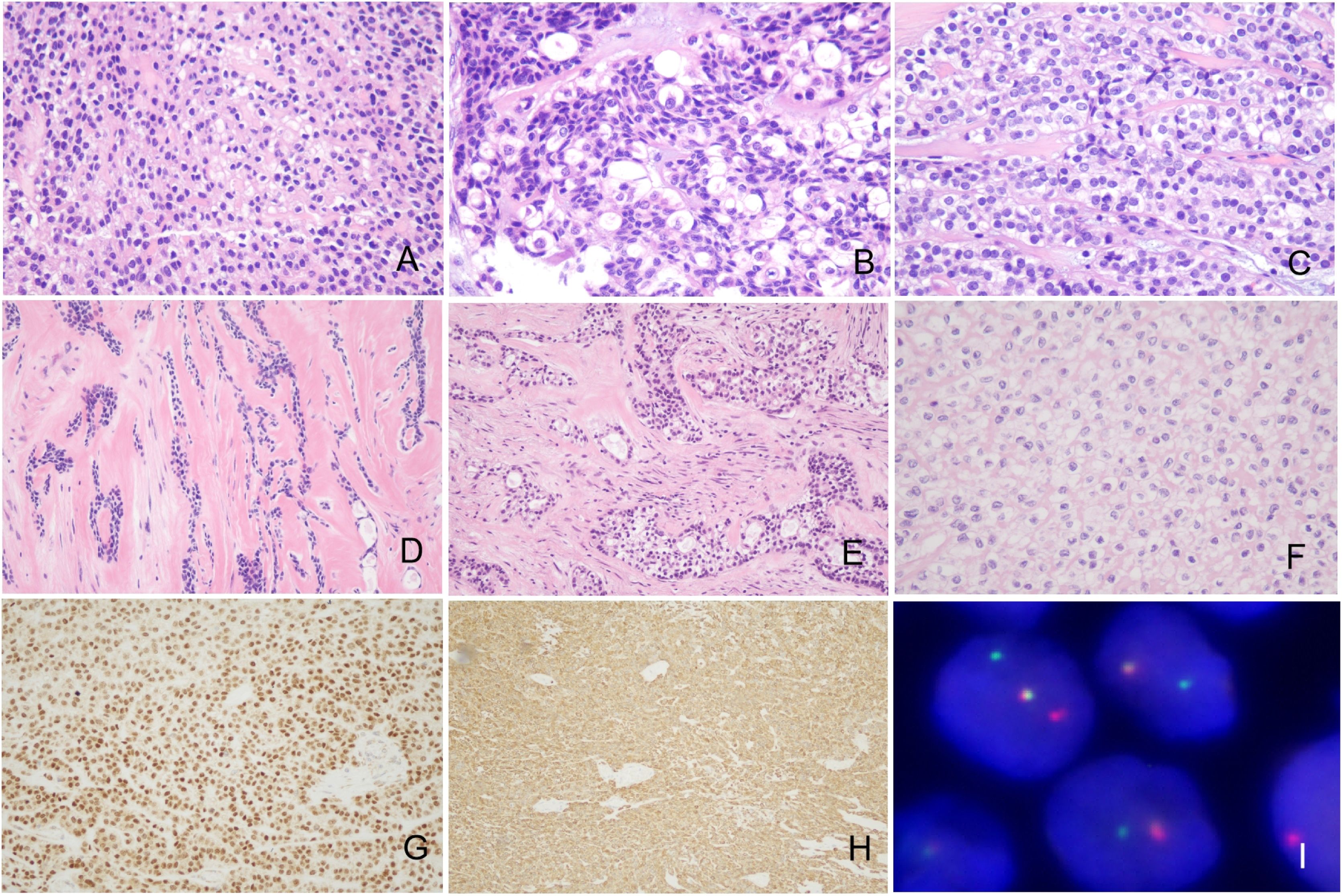 Clinicopathological analysis of hyalinizing clear cell carcinoma in the ...