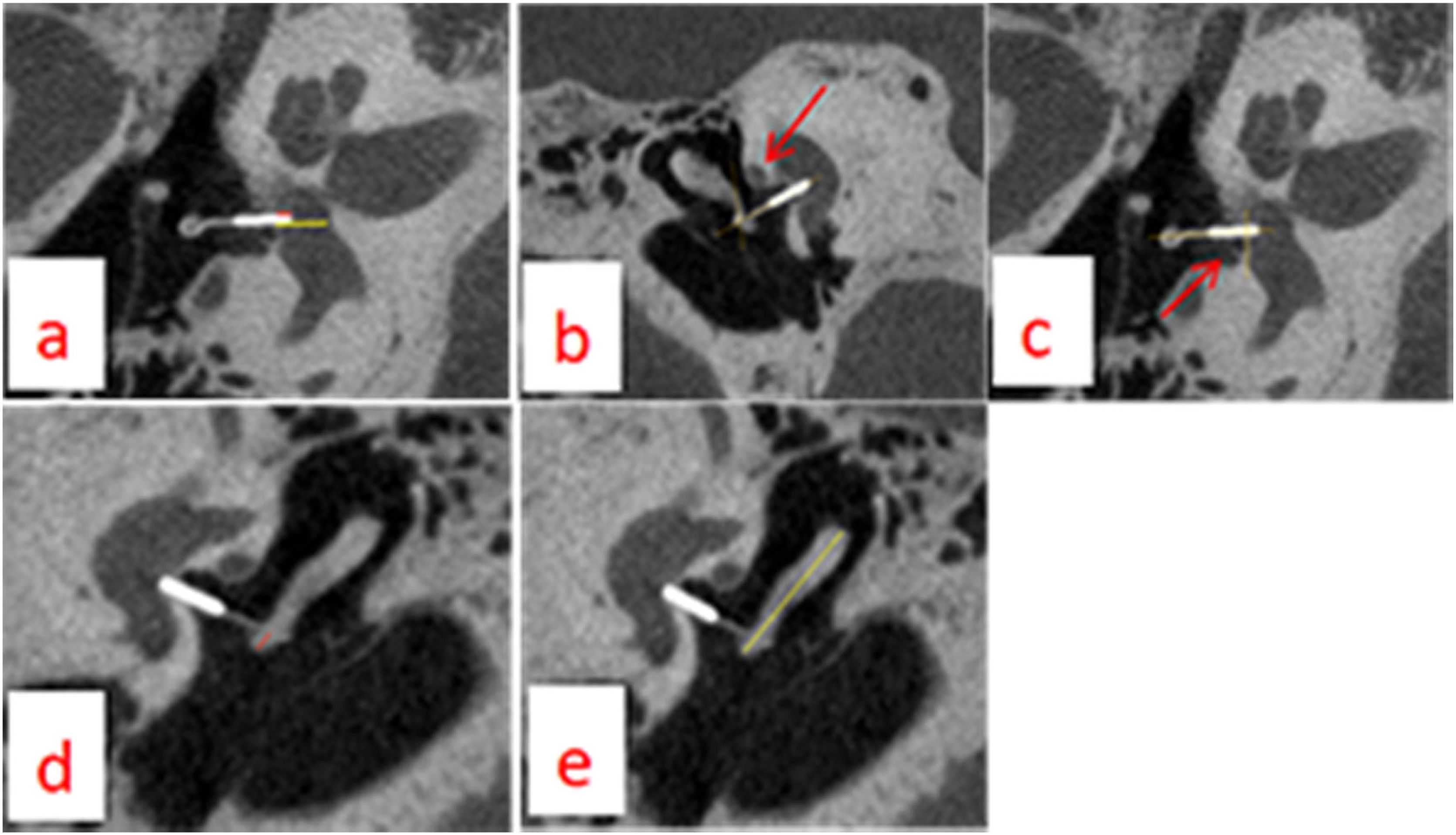Impact of prosthesis position on hearing outcomes in otosclerosis ...