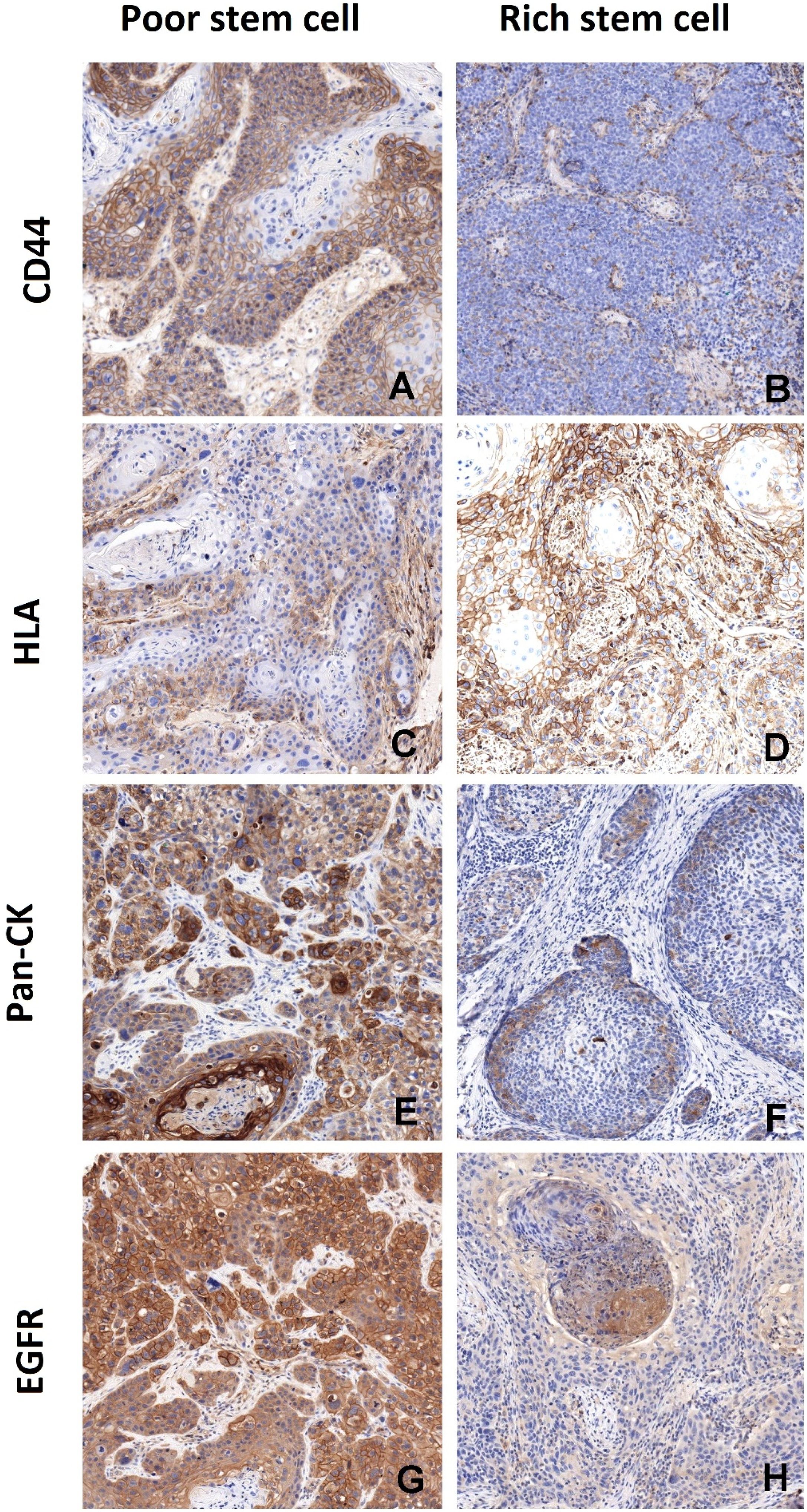 Cancer stem cell biomarkers in locally advanced head and neck squamous ...