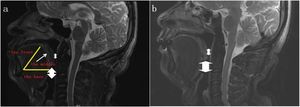 Midsagittal MRI of OSAS patients (a) and normal controls (b) at the velopharyngeal plane. The middle part of the tongue is attached to soft palate in both groups. However, only Figure (a) shows backward movement of the soft palate, resulting in collapse of the velopharyngeal plane.