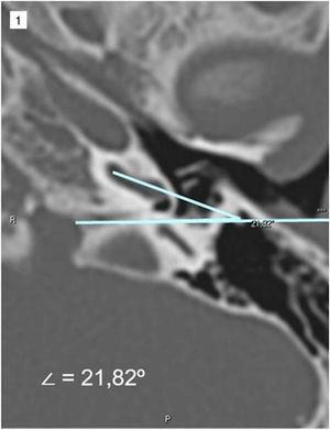 Example of round window membrane angle measurement, facial nerve in the coronal plane (RWM-FN-CP). The picture shows a line that passes tangent to the round window niche (anterior lip), since round window size and shapes may vary the radiologist used this bony landmark as other tomography-based works.