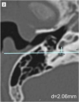 Example of vertical distance measurement between the Round Window Membrane and the Facial Nerve (RWM-FN). The line passing through the ampulla of the posterior semicircular canal is at the same height as the facial nerve.