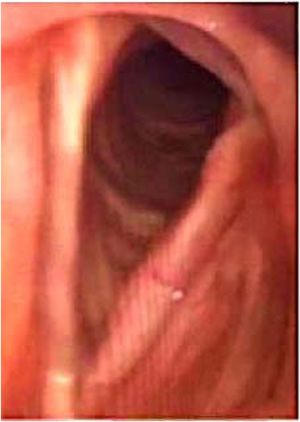 Preoperative laryngoscopy, T1b with larger component on the left.