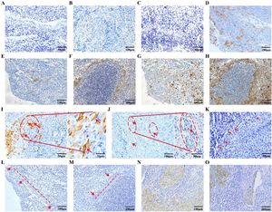 Spindle-shaped CXCR4+ cells in NPC tumor and rhinitis non-tumor tissues. (A) CXCR4 expression (non-detectable) in nasopharyngeal rhinitis tissue; (B‒D) CXCR4 expression in nasopharyngeal carcinoma tissues, (B) Non-deectable, (C) Weakly positive (≤10% of all cancer cells) and (D) Strongly positive (≥10% of all cancer cells); (E‒F) Immunohistochemical staining of CXCR4 in nasopharyngeal primary carcinoma tissues and secondary lymph node metastases; (G‒H) Pan-CK immunohistochemical staining in serial sections of nasopharyngeal primary carcinoma tissues and secondary lymph node metastases. Overlapping expression of CXCR4 and PAN-CK can be seen (1E and 1G; 1F and 1H). Most CXCR4+ cells were also CK+; (I) Cell membrane and cytosolic expression of CXCR4 in nasopharyngeal carcinoma cells. CXCR4+ cells were usually spindle-shaped; (J) A single or small number of CXCR4+ cells may be seen in the micrometastatic foci of lymph node metastatic cancer tissues; (K) CXCR4+ cells can be seen in tight clusters at the edges of tumor tissues; (L‒M) A line of CXCR4+ NPC cells may be seen, perhaps indicating migratory activity (red line); (N) Most metastatic NPC cells in lymph node tissue expressed CXCR4; (O) CXCR4+ NPC cells in the vasculature.