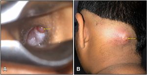 (A) Otomicroscopy demonstrated an attic (epitympanic) perforation with whitish desquamated debris, partially obscured by granulation tissue (yellow arrow). (B) Pre-operative photograph showing an abscess in the occipital region (yellow arrow).