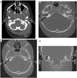 (A) Axial CT scan showing a soft tissue swelling at occipital region (red arrow). (B) Axial CT scan (bone window) showing lesion in the mastoid bone with erosion of the sinus plate (yellow arrow). (C) Axial CT scan showing intact cortical bone (blue arrow). (D) Coronal CT scan showing intact cortical bone (green arrow).