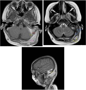 (A) T1WI MRI post contrast axial showing sigmoid sinus thrombosis (red arrow) and scalp abscess (pink arrow) connected with emissary vein (yellow arrow). (B) T2 WI axial MRI showing long sinus tract extended from the mastoid cavity to the soft tissue of left occipital region (blue arrow) connecting multiple abscess (yellow arrow). (C) Post contrast Sagittal T1WI MRI showing communication between infected sigmoid sinus and scalp lesion through emissary vein (yellow arrow) across the mastoid foramen.