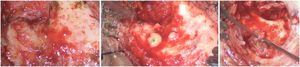 (A) Intact cortical bone (white star). (B) Erupting pus after removal of cortical bone (green star). (C) Decompressing the thrombosed lateral sinus (yellow star).