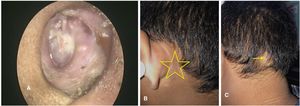 (A) Well-epithelialized dry mastoid cavity with intact neo tympanic membrane. (B) Healed postauricular region (yellow star). (C) Healed occipital abscess site (yellow arrow).