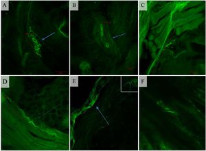 Immunofluorescence analysis of the palatoglossus muscle in the studied groups. (A) Control group (×20): Ruffini-like non-encapsulated formation (arrow) within the muscular layer. (B) Control group (×20): Meissner-like corpuscle (arrow) in connective tissue; (C) Control group (×20): Diffuse nerve bundles distributed within the muscle fibers, constituting a muscle spindle; (D) Control group (×20): Elongated nerve structures in spiral format (spiral-wharves) running parallel do muscle fibers. (E) Case group (×10): Subepithelial nerve fibers with progressive reduction in width running parallel to muscle fibers. (F) Case group (×20): Spiral-wharve nerve formation immerse in sparse muscular fibers.