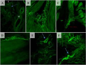 Immunofluorescence analysis of the palatopharyngeus muscle in the studied groups. (A) Control group (×10): Thin and tortuous free nerve endings (arrow) in the epithelial layer running towards blood Vessels (VS). B. Control group (×20): Complex Golgi-like nerve formation; (C) Control group (×20): Ruffini-like non-encapsulated formation. (D) Case group (×20): Non-classifiable nerve formation. (E) Case group (×10): Golgi-like nerve formation. (F) Case group (×20): Spiral-wharves nerve formation.
