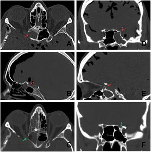 Pre- and postoperative CT scans of Cases 1 and 2. (A and B) Axial and sagittal preoperative views of Case 1 showing marked pneumocephalus and the defect area (red arrow). (C) Postoperative axial view of Case 1 showing resolution of the defect (green arrow). (D and E) Coronal and sagittal preoperative views of Case 2 showing pneumocephalus and the defect (red arrow). (F) Postoperative coronal view showing resolution of the defect and absence of pneumocephalus (green arrow).