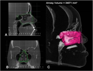 Volumetric analysis of nasal cavity. (A and B) Manual delimitation in sagittal and coronal sections, respectively. (C) Determination of volume of nasal cavity using airway analysis tool of Dolphin Imaging software.