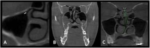 (A) CT image (coronal section) showing position of right maxillary ostium. (arrow). (B) CT image (coronal section) showing thickening of maxillary sinus mucosa bilaterally. (C) CT image (coronal section) showing nasal septum deviation using angular measurement tool of Dolphin Imaging software.