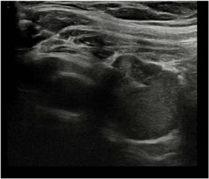 Ultrasound-guided FNA of a right thyroid nodule.