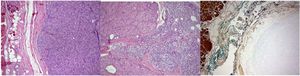 (A) Solid neoplastic proliferation composed of oncocytic cells with eosinophilic cytoplasm. (B) Area of capsular invasion and close contact with parathyroid tissue. (C) The lesion does not express thyroglobulin on immunohistochemistry (non-tumoral thyroid parenchyma positive as internal control on the left).