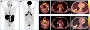 Maximum Intensity Projection (MIP) of 18F-PSMA-1007 (A) and 18F-FDG (B) PET/CT images of a patient with right-sided oropharyngeal squamous cell carcinoma and mediastinal and pulmonary metastases (Patient 13). Axial slices of fused 18F-PSMA PET/CT images of the head and chest (soft tissue and pulmonary windows) are shown in (C), and the corresponding slices of 18F-FDG PET/CT are shown in (D). Lesion uptake of both tracers is seen in the primary site, located in the right pharyngeal tonsil (solid arrows), with more intense and extensive for 18F-FDG (SUVmax1 h: 10.7, SUVmax2 h: 12.9) than for 18F-PSMA-1007 (SUVmax90 min: 3.0, SUVmax2 h: 4.4). Additionally, multiple metastatic mediastinal lymph nodes, including upper and lower paratracheal, subcarinal, and right hilar chains are seen with both tracers (dashed arrows), with markedly higher FDG uptake (SUVmax2 h up to 34.4) than PSMA uptake (SUVmax2 h up to 6.9). A spiculated pulmonary mass is also identified in the posterior basal segment of the right lower lobe, with intense FDG uptake (SUVmax2 h: 25.9) and moderate PSMA uptake (SUVmax2 h: 15.7), consistent with pulmonary metastasis (arrowheads).