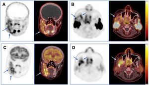 Coronal (A) and axial (B) slices showing PET (right) and fused PET/CT images (left) obtained with 18F-PSMA-1007 from a patient with squamous cell carcinoma of the right retromolar trigone, with bone invasion (Patient 6). The corresponding 18F-FDG images are shown in (C) and (D). Lesion uptake of both tracers is clearly seen in the ill-defined primary lesion (arrows). However, their intralesional patterns differ markedly: 18F-PSMA-1007 displays peripheral uptake (A and B), likely reflecting PSMA expression in the tumor