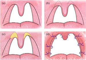 Han’s Uvula-Preserving UPPP technique. (a) Intraoperative view of the oropharynx, demonstrating the uvula and soft palate. (b) Partial resection of the soft palate and lateral pharyngeal wall mucosa with preservation of the uvula. (c) Wound closure showing the enlarged anteroposterior and transverse diameters of the pharyngeal airway. (d) Immediate postoperative view of the oropharynx.