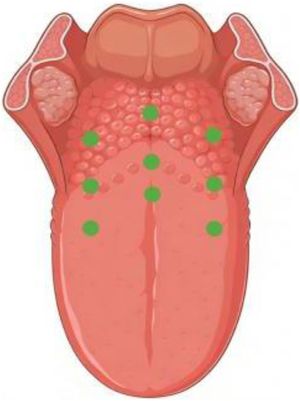 3 × 3 radio-frequency ablation pattern at the base of tongue.
