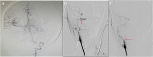Intraoperative fluoroscopic imagings: (A) The left vertebral artery is thickened and tortuous. The right middle cerebral artery and anterior cerebral artery are well displayed through posterior communicating artery (red arrow). (B) Both the right internal and external carotid arteries were significantly stenosed with a pseudoaneurysm noted in the C3 segment of the right ICA (red arrow). (C) The pseudoaneurysm was embolized using spring coils and complete resolution was observed after embolization (red arrow).