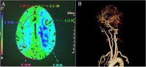 Post-operative imagings: (A) CT scan revealed cerebral infarction in the right parietal and left frontoparietal lobes. (B) Head and neck CTA showed bilateral ICA occlusion involving the C1-4 segments (red arrow).