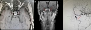 MRI findings before and after radiotherapy, and Intraoperative fluoroscopic imaging’s: (A) Pre-radiotherapy (April 2022): The C3 segment of both ICAs appeared normal, with a regular diameter. (B) One month after radiotherapy (August 2022): Bilateral stenosis of the ICA C3 segment was observed. (C) April 2023: Significant stenosis of the left ICA C3 segment was noted.