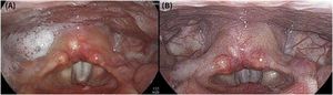 Laryngoscopic follow-up. (A) One month postoperatively: intact gross vocal fold mobility with notable saliva pooling in the right pyriform sinus. (B) Three months postoperatively: optimal vocal fold tension and complete resolution of saliva pooling.