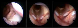 Nasofibrolaryngoscopy of Case 1 at the first assessment. The image on the left shows secretion in the left middle meatus; the central image shows the initial aspect of the larynx (vocal folds with preserved mobility, marked hyperemia, and a whitish, opaque, elevated area involving the middle third of the membranous portion and extending to part of the anterior and posterior thirds of both vocal folds); the image on the right was obtained with the device positioned closer to the glottis, where the elevated lesion can be observed.