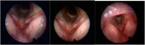 Nasofibrolaryngoscopy of Case 1. The left image taken one week after treatment; the central image taken after two weeks; and the image on the right taken one month later.