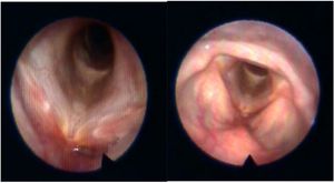 Nasofibrolaryngoscopy of Case 1, image on the left taken 45-days after treatment, and image on the right taken after three months, with resolution of lesions.