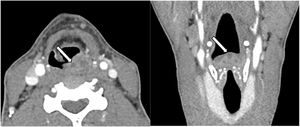 Axial and coronal post-contrast CT images before the first hospitalization demonstrate diffuse thickening and heterogeneous enhancement of the aryepiglottic folds, more pronounced on the left, where a poorly defined oval hypoattenuating area is observed (arrows).